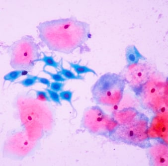 Metaplasia squamosa nel Pap test