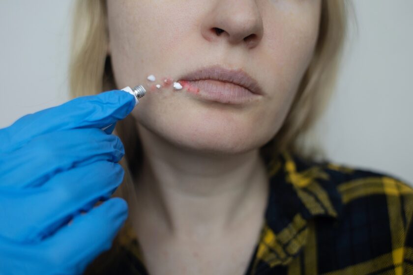 Herpes labiale rimedi: mano con guanto blu applica una crema sulla zona arrossata accanto al labbro di una donna